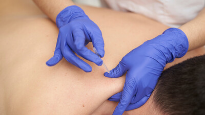 Dry needling of a neck and shoulder lying down by a therapist