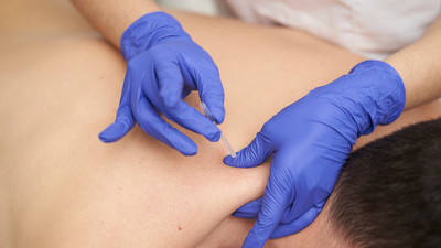 Dry needling of a neck and shoulder lying down by a therapist