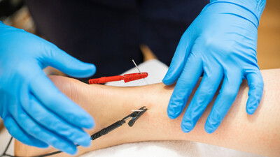 dry needling in an ankle with an e-stim unit in treatment